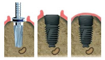 Spécialiste implant dentaire 67