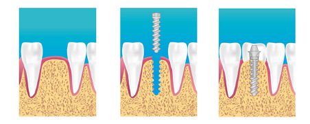 Implants dentaires Neudorf 67